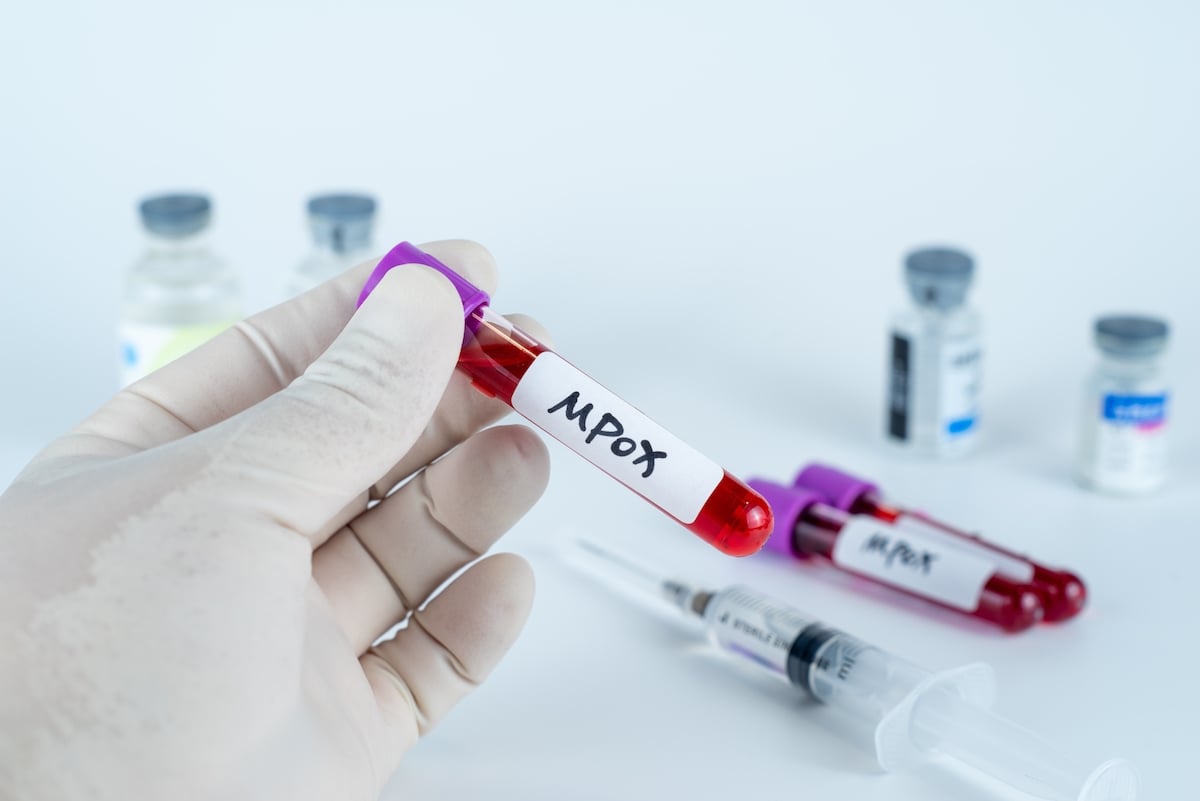 Virus mpox : importation irrégulière et sécurité biologique